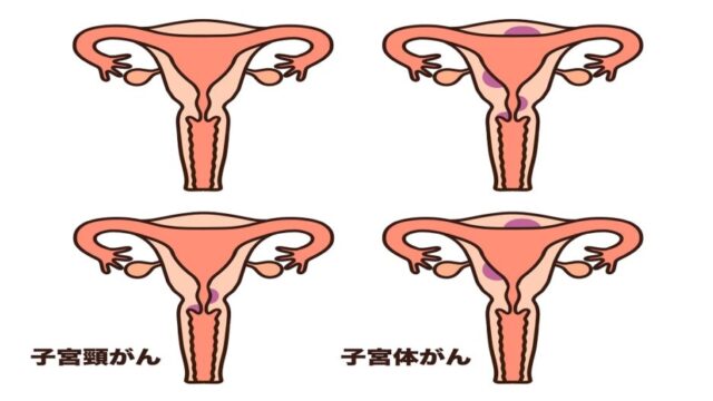 子宮がんの説明図