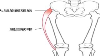 末期の変形性股関節症の原因となった大腿筋膜張筋