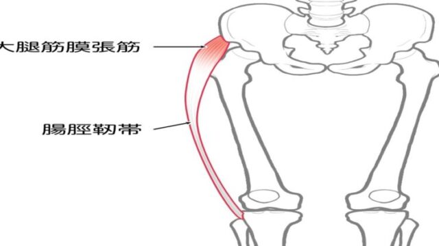 末期の変形性股関節症の原因となった大腿筋膜張筋