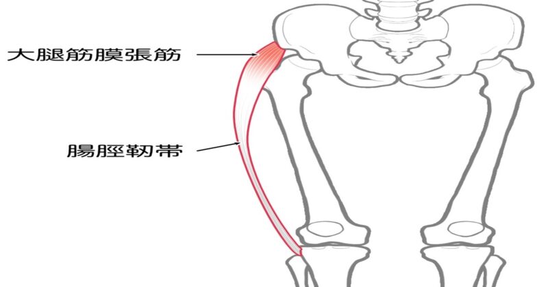 末期の変形性股関節症の原因となった大腿筋膜張筋