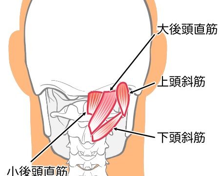 頭痛の原因となる後頭下筋群