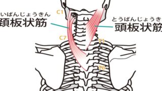 片頭痛の原因となる板状筋群