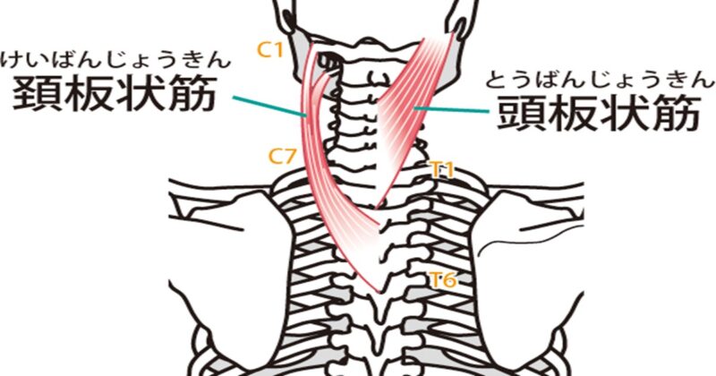 片頭痛の原因となる板状筋群