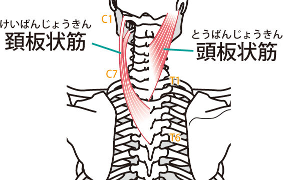 頭痛の原因となる頭板状筋